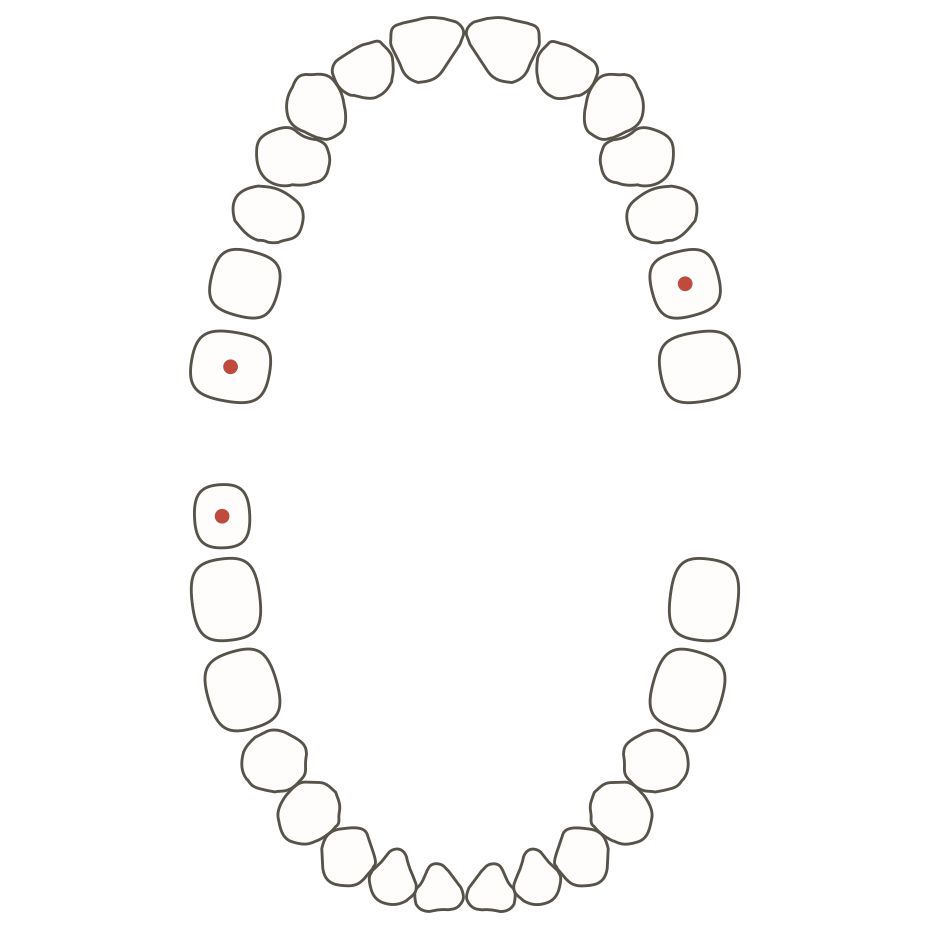 Mouth diagram of an adult: full permanent dentition with one erupted wisdom tooth, three molars marked with red treatment dots