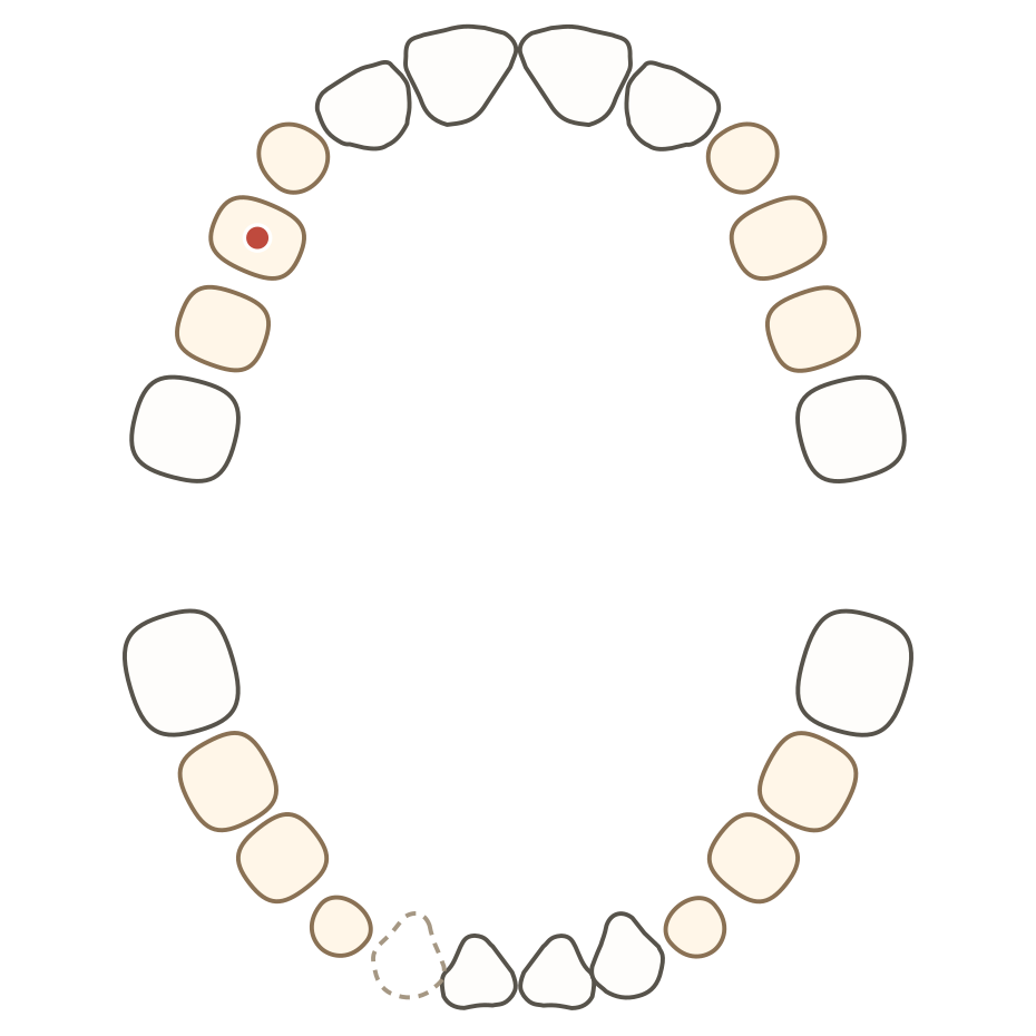 Mouth diagram of an eight-year-old: milk and permanent teeth mixed, one gap, one tooth marked with a problem dot